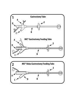 AVANOS* Gastrostomy Feeding Tubes